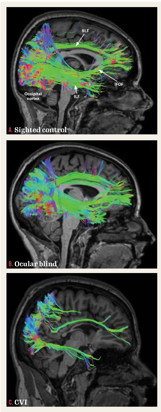 White matter reconstruction (shown in sagittal view) of 3 main pathways involved in the processing of visual information, namely, the superior longitudinal fasciculus (SLF) (the neuroanatomical correlate of the dorsal visual processing stream), the inferior longitudinal fasciculus (ILF) (the ventral visual processing stream), and the inferior fronto-occipital fasciculus (IFOF) (mediating visual attention and orienting). The 3 white matter pathways are reconstructed in (A) in a normal sighted/developed control, (B) early ocular blind person, and (C) in CVI in a person with associated periventricular leukomalacia. The ILF, SLF, and IFOF are fully reconstructed in the control and early ocular blindness. In contrast, the SLF and ILF are sparser, and the IFOF would not be reconstructed in the individual with CVI. These differences in the structural integrity along these major white matter pathways may be related to observed cognitive visual dysfunctions in CVI.2