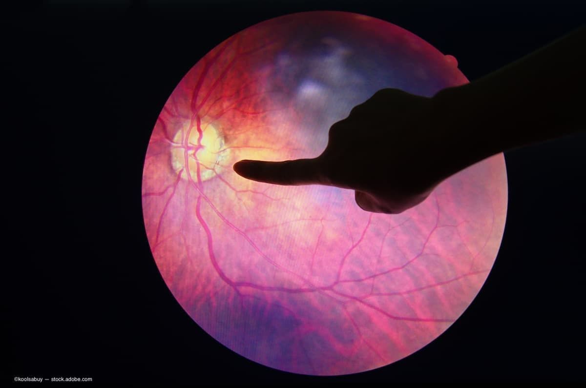 an image of a doctor pointing to a scan of a retina with diabetes. (Image Credit: AdobeStock/koolsabuy)