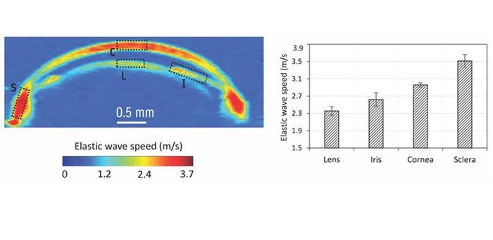 A newly developed noninvasive imaging technique combines acoustic radiation force and optical coherence tomography to produce 3D elastic wave speed maps of multiple eye components simultaneously. Left: Cross-sectional image of a wave speed map of the anterior segment of the eyeball depicting different eye components: lens (L), iris (I), cornea (C), and sclera (S). Right: Bar graph comparing the elastic wave speed of these components. (Image courtesy of Mekonnen et.al.)


