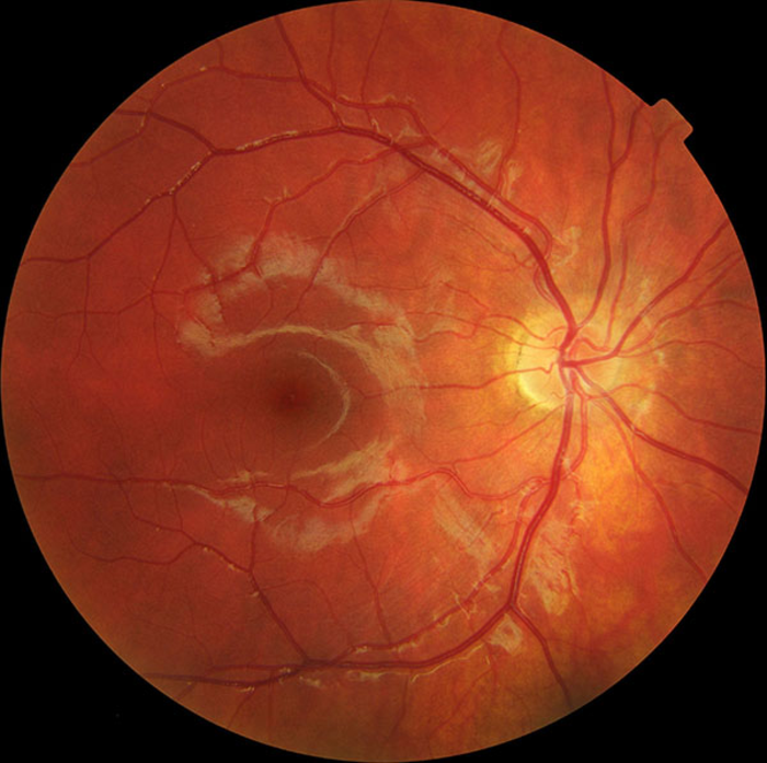 Macula dystrophy can occur when photoreceptor cells comprising the retina at the back of the eye progressively become impaired and unable to function fully, leading to loss of full vision and perhaps blindness. (Image courtesy of Ralf Roletschek)