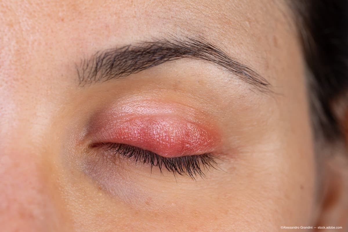 Blog: Managing patients with MGD and Demodex blepharitis
