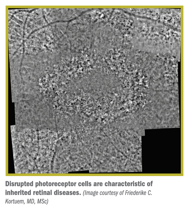 Disrupted photoreceptor cells are characteristic of inherited retinal diseases. 