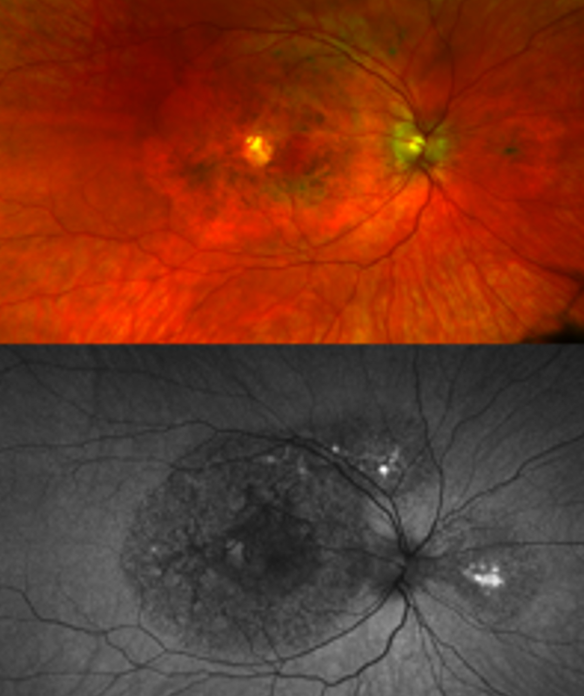 Retinal images of a patient with a TIMP3 mutation causing atypical symptoms. While there is visible damage in the retina (dark circles), there is no CNV present. (Image courtesy of NEI)
