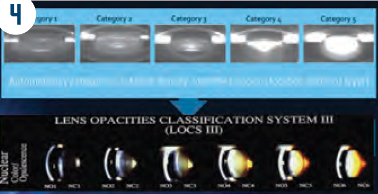 Automated cataract density grading vs LOCS III.