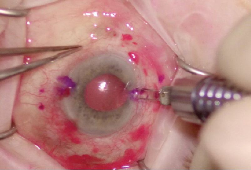 Making sutureless double-needle scleral IOL fixation technique more accessible