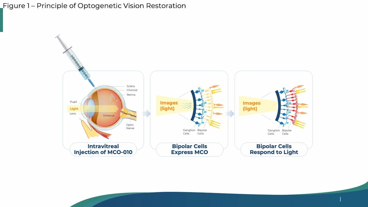 Figure 1. Principle of Optogenetic Vision Restoration (Images courtesy of Allen C. Ho, MD, FACS, FASRS)