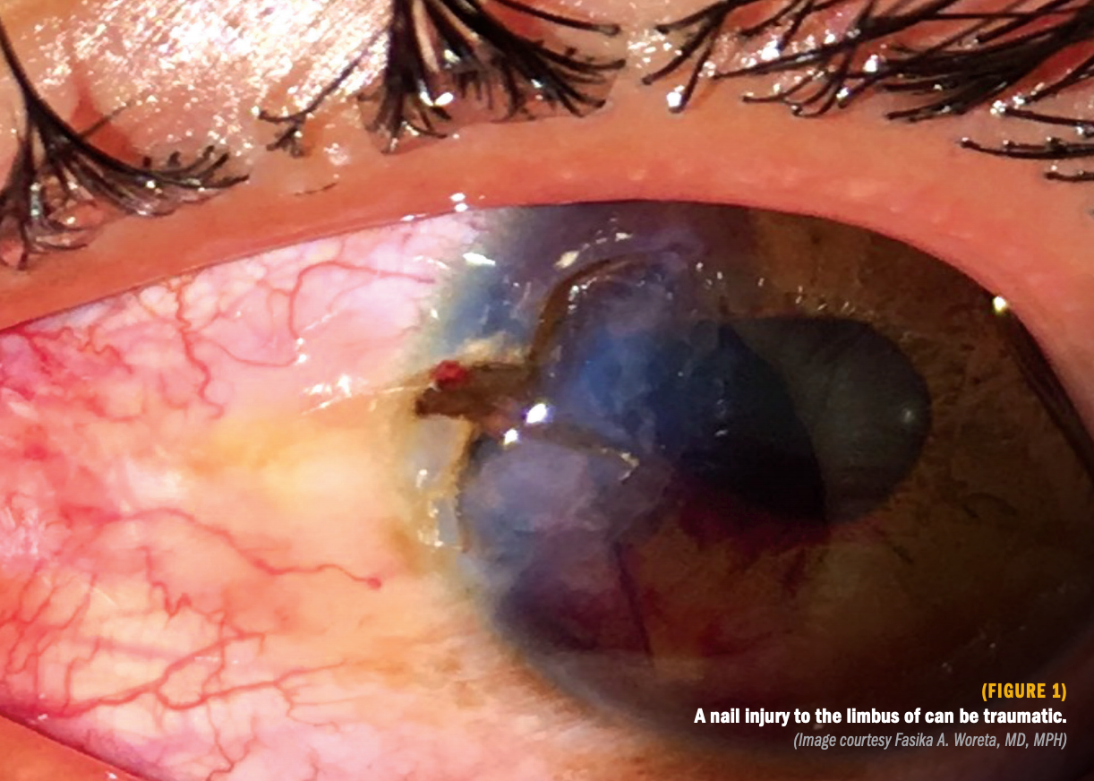 Options for managing the iris after trauma