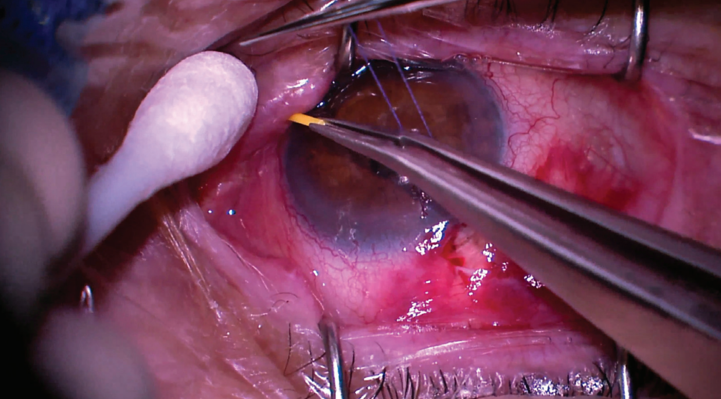 The dexamethasone ophthalmic insert is implanted in a patient. (Image courtesy of Kevin Jackson, MD)