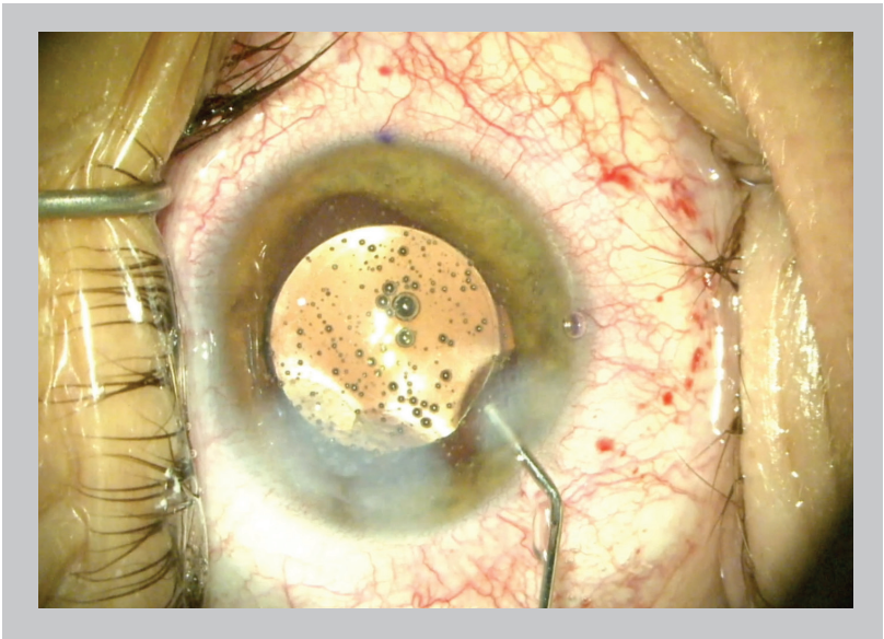 The placement of antibiotic after cataract surgery.