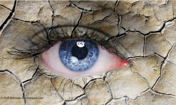 Brimonidine therapy well tolerated for treatment of dry eye disease