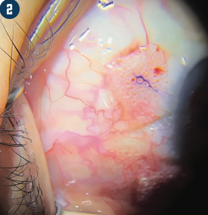 Figure 2: The microporation matrix can be seen under surgical microscopic magnification but is not visible without magnification.