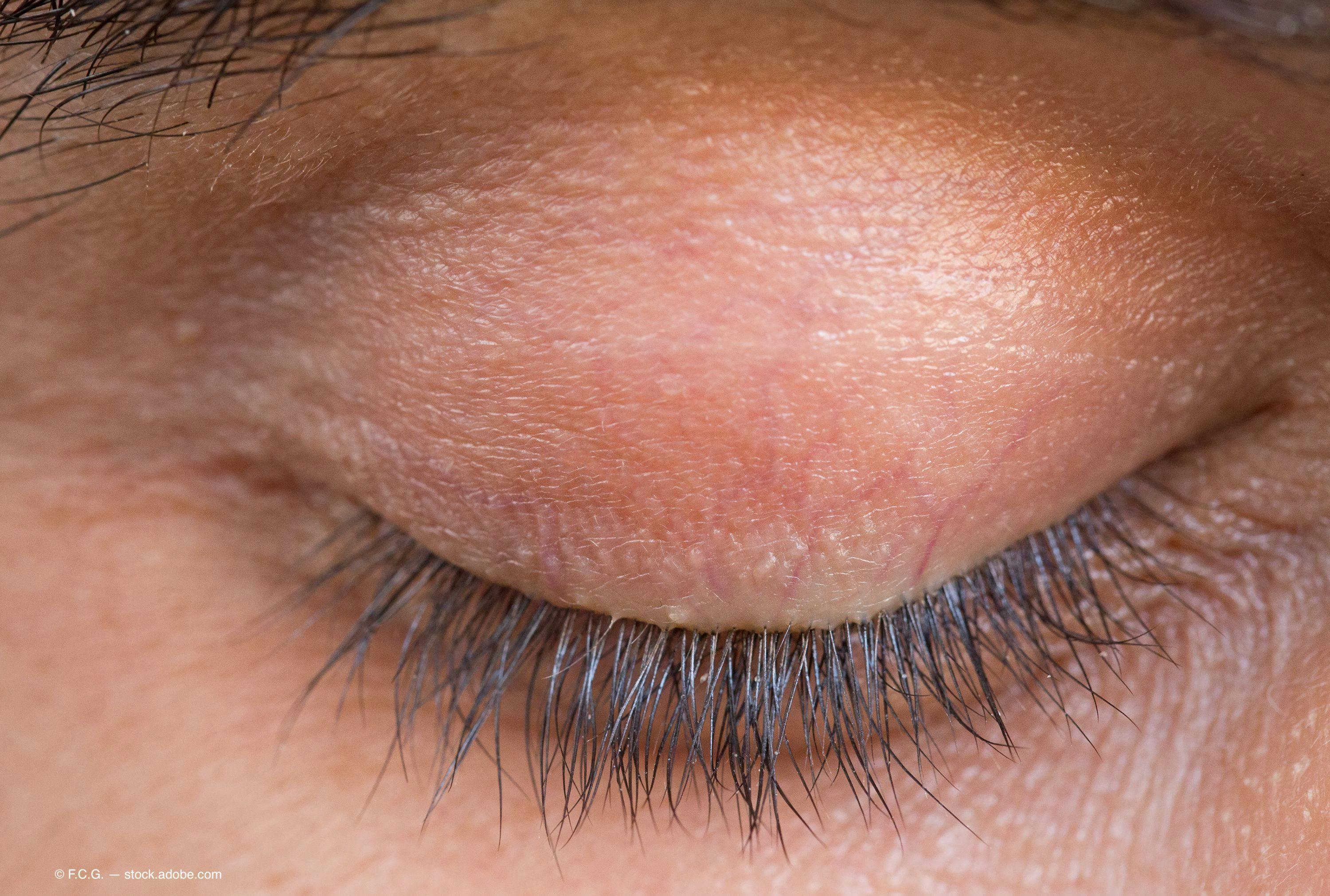 Upper lid elevation with topical oxymetazoline 0.1%: providing a better view