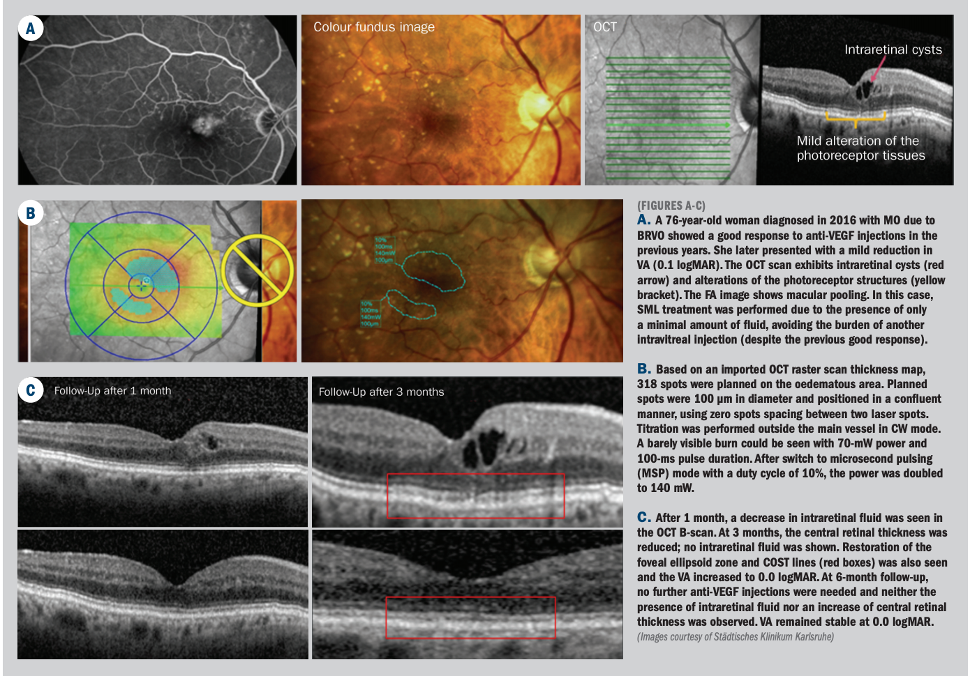 Micropulse laser therapy safe treatment for retinal disorders
