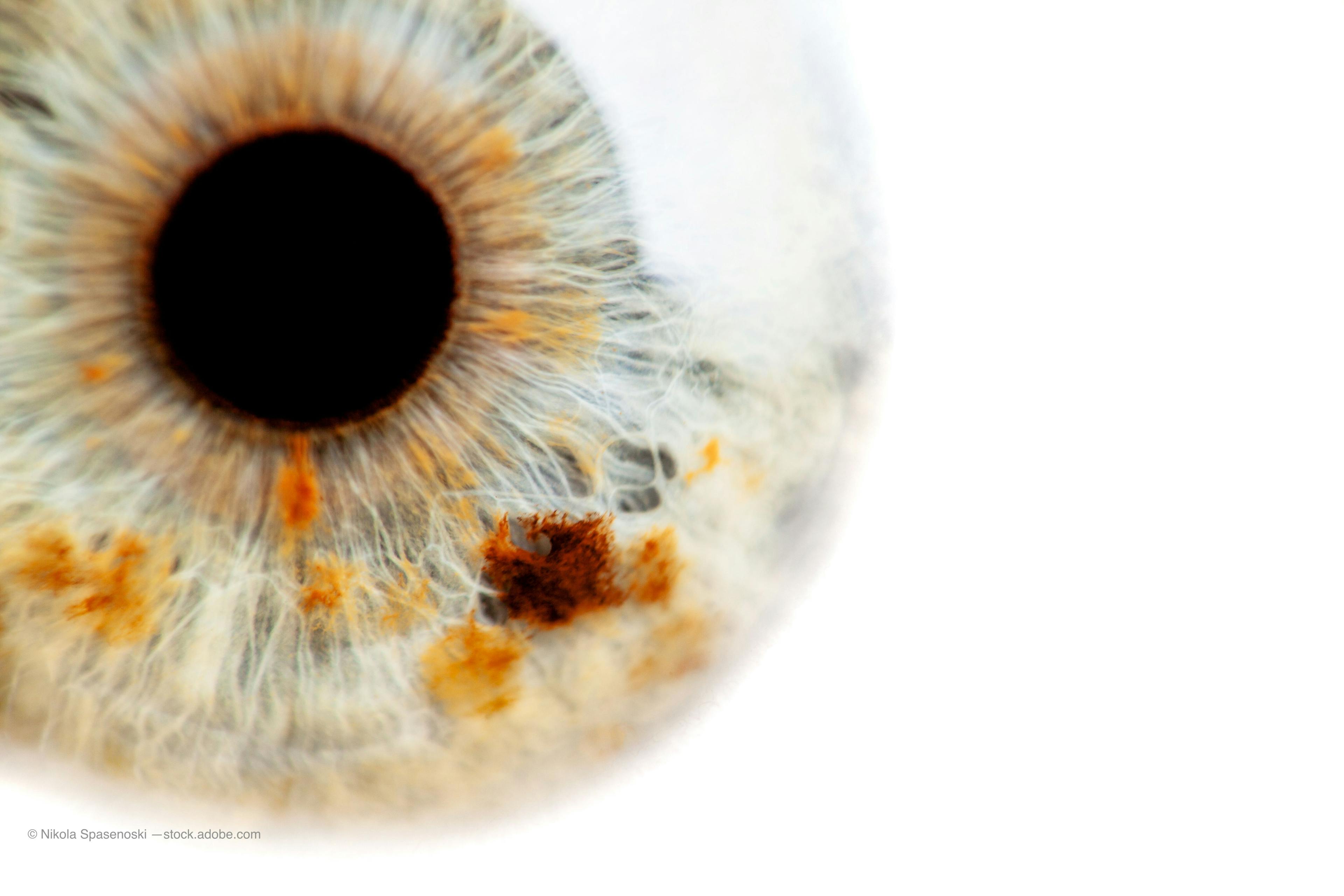 An eye toward plateau iris and its implications