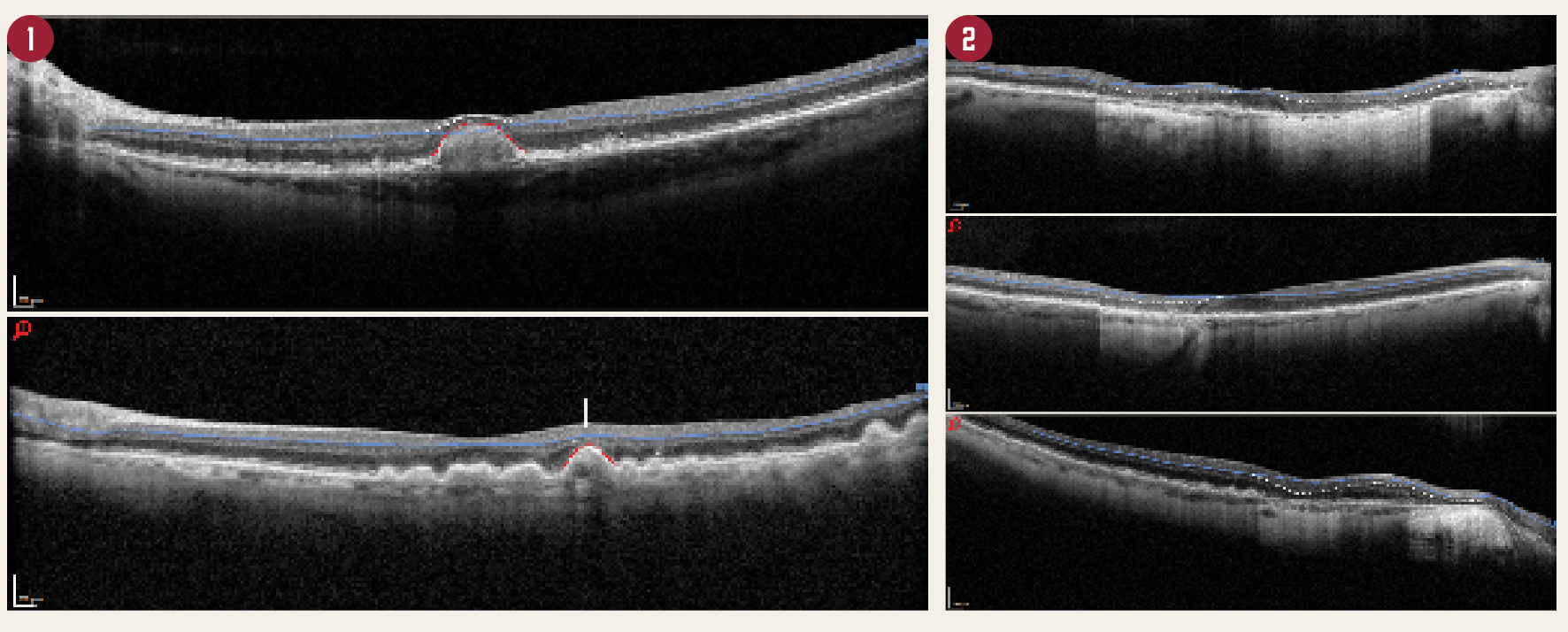 Effect of drusen and atrophy in dry AMD on automated segmentation in OCT images 