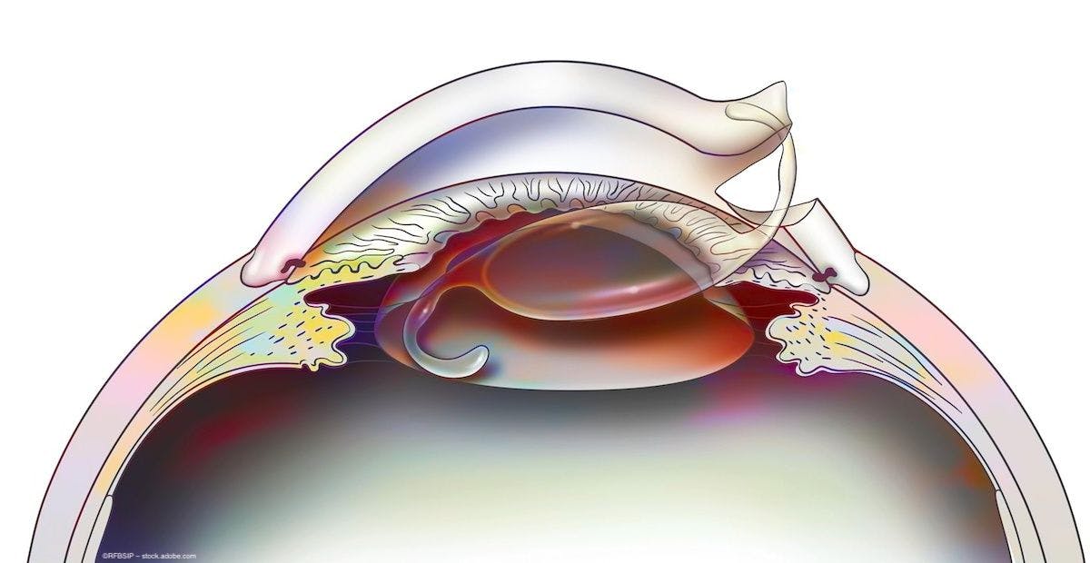 An illustration of an intraocular lens being inserted into the eye. Image credit: ©RFBSIP – stock.adobe.com